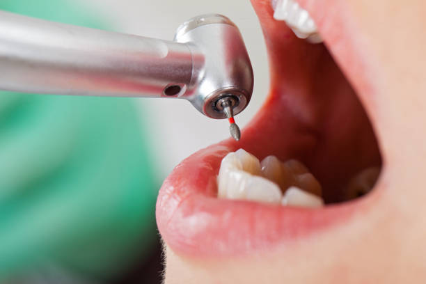 Best Emergency Wisdom Teeth Removal in Garden Ridge, TX